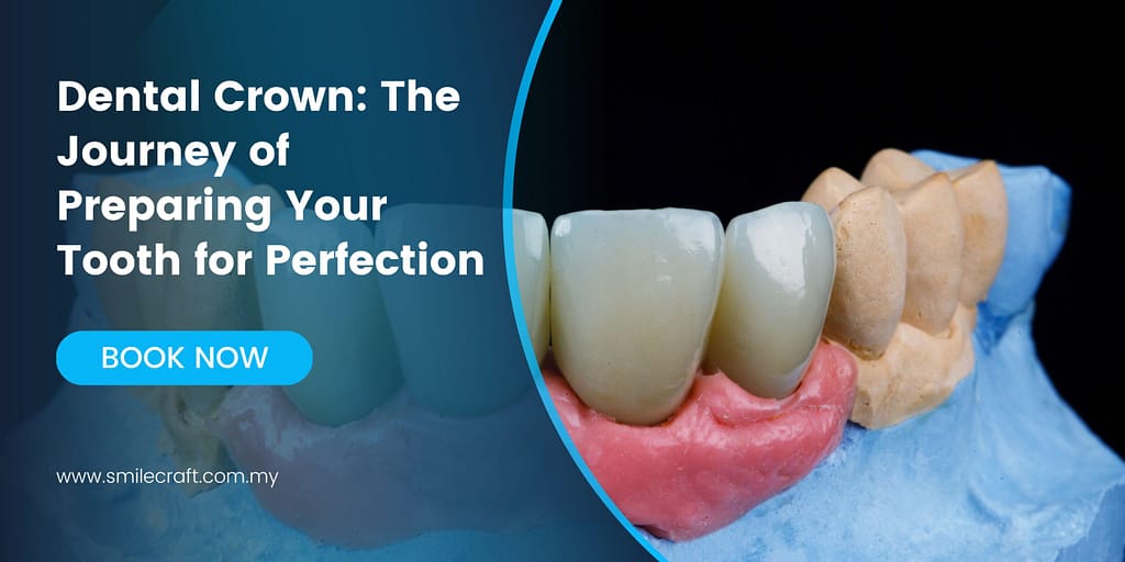 Dental Crown: The Journey of Preparing Your Tooth for Perfection