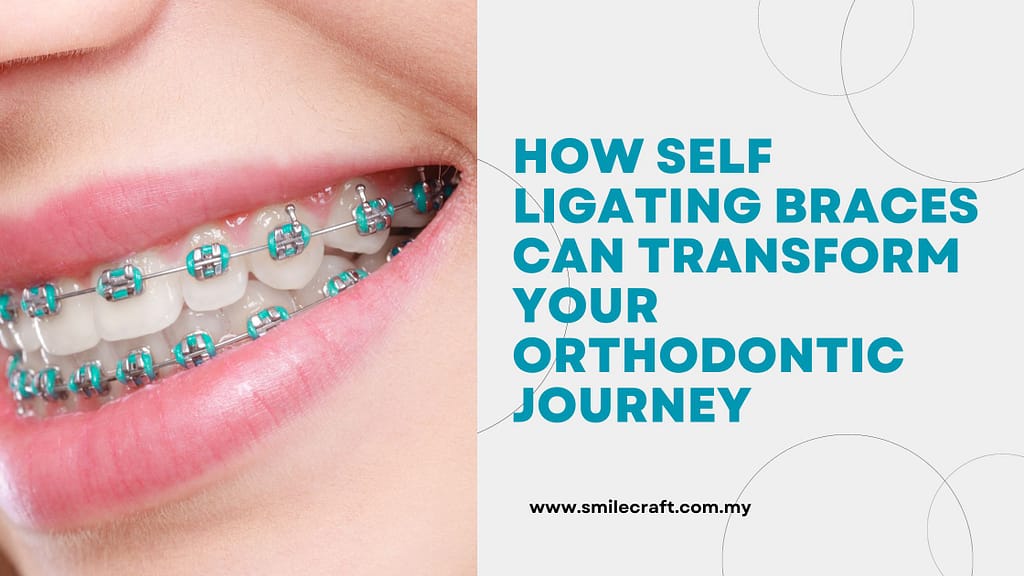 How Self Ligating Braces Can Transform Your Orthodontic Journey