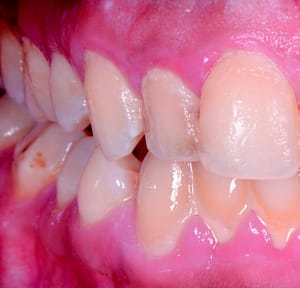 teeth scaling puchong