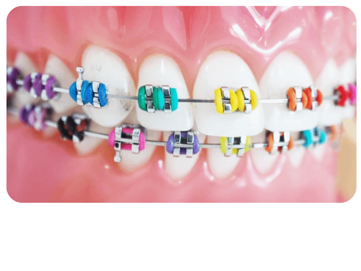conventional braces puchong