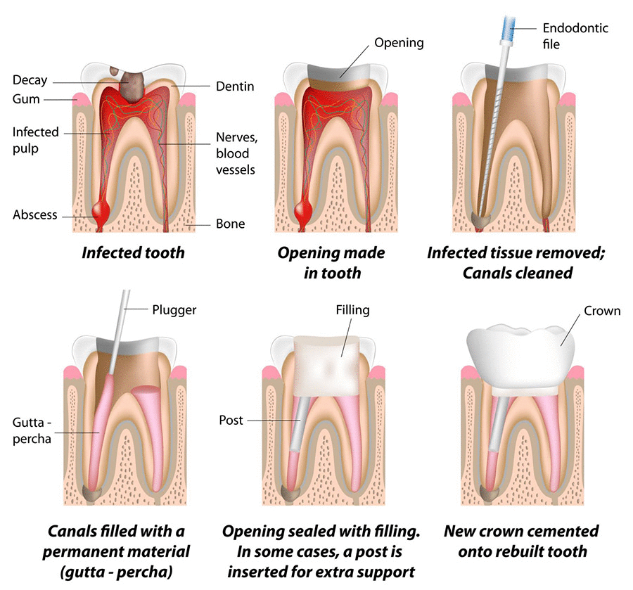 root-canal-treatment-illustration-bd1a10