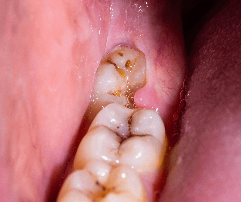 Wisdom tooth surgery